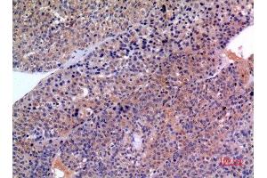 Immunohistochemistry (IHC) analysis of paraffin-embedded Human Liver Cancer, antibody was diluted at 1:100. (SCCA1/2 (Internal Region) 抗体)