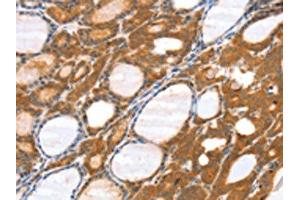 The image on the left is immunohistochemistry of paraffin-embedded Human thyroid cancer tissue using ABIN7131182(SRGAP3 Antibody) at dilution 1/40, on the right is treated with fusion protein. (SRGAP3 抗体)