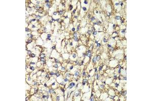 Immunohistochemistry of paraffin-embedded human kidney cancer using PTGES2 antibody. (PTGES2 抗体  (AA 88-377))