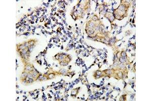 IHC-P: Caspase-8 antibody testing of human breast cancer tissue