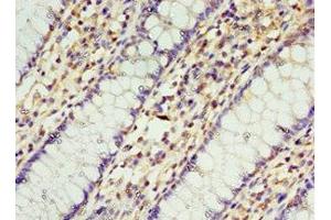 Immunohistochemistry of paraffin-embedded human colon cancer using ABIN7168957 at dilution of 1:100 (STRAP 抗体  (AA 1-350))