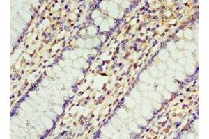 Immunohistochemistry of paraffin-embedded human colon cancer using ABIN7168957 at dilution of 1:100