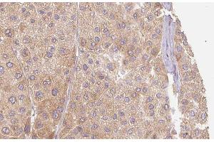 ABIN6277408 at 1/100 staining Human Melanoma tissue by IHC-P. (MMP11 抗体  (N-Term))