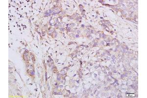 Formalin-fixed and paraffin embedded human esophageal carcinoma labeled with Anti phospho-PKA R2 (Ser96) Polyclonal Antibody, Unconjugated (ABIN752668) at 1:200 followed by conjugation to the secondary antibody and DAB staining