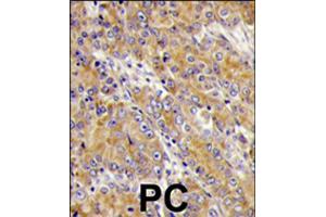 Formalin-fixed and paraffin-embedded human prostate carcinoma tissue reacted with MYO1C polyclonal antibody  , which was peroxidase-conjugated to the secondary antibody, followed by DAB staining . (Myosin IC 抗体  (C-Term))