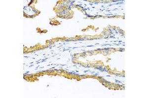 Immunohistochemistry of paraffin-embedded human prostate cancer using CPB2 antibody at dilution of 1:100 (40x lens). (CPB2 抗体)