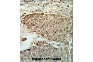 Formalin-fixed and paraffin-embedded human hepatocarcinoma reacted with BIN3 Antibody (N-term), which was peroxidase-conjugated to the secondary antibody, followed by DAB staining. (BIN3 抗体  (N-Term))