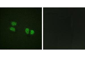 P-peptide - +Immunohistochemistry analysis of paraffin-embedded human breast carcinoma tissue using DDX5/DEAD-box Protein 5 (Phospho-Tyr593) antibody. (DDX5 抗体  (pTyr593))