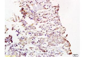 Formalin-fixed and paraffin embedded human breast carcinoma labeled with Rabbit Anti Phospho-MEK1/2(Ser218/222) Polyclonal Antibody, Unconjugated (ABIN743813) at 1:200 followed by conjugation to the secondary antibody and DAB staining (MEK1/2 抗体  (pSer218, pSer222))