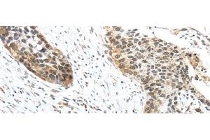 Immunohistochemistry of paraffin-embedded Human esophagus cancer tissue using TRIP6 Polyclonal Antibody at dilution 1:50 (TRIP6 抗体)