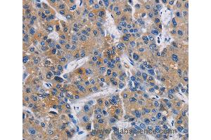 Immunohistochemistry of Human liver cancer using GPM6A Polyclonal Antibody at dilution of 1:40 (GPM6A 抗体)