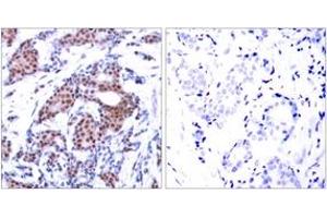 Immunohistochemistry analysis of paraffin-embedded human breast carcinoma, using Elk1 (Phospho-Ser383) Antibody. (ELK1 抗体  (AA 351-400))