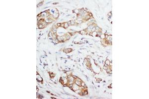 Anti-IGF1 antibody, IHC(P) IHC(P): Human Mammary Cancer Tissue (IGF1 抗体  (Middle Region))