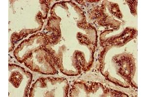 Immunohistochemistry of paraffin-embedded human prostate cancer using ABIN7143803 at dilution of 1:100 (ST8SIA5 抗体  (AA 101-376))