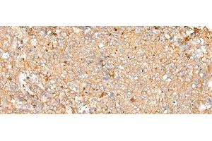 Immunohistochemistry of paraffin-embedded Human cervical cancer tissue using PRDX4 Polyclonal Antibody at dilution of 1:25(x200) (Peroxiredoxin 4 抗体)