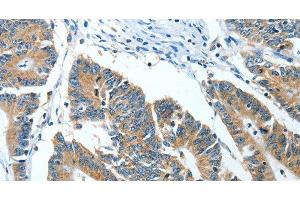 Immunohistochemistry of paraffin-embedded Human colon cancer tissue using ANGPT1 Polyclonal Antibody at dilution 1:50 (Angiopoietin 1 抗体)