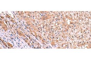 Immunohistochemistry of paraffin-embedded Human liver cancer tissue using TTC38 Polyclonal Antibody at dilution of 1:85(x200) (TTC38 抗体)