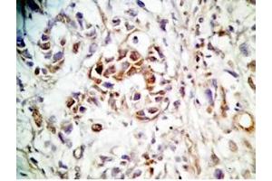 Human stomach cancer tissue was stained by rabbit anti-Spexin(H) Antiserum (Spexin 抗体)