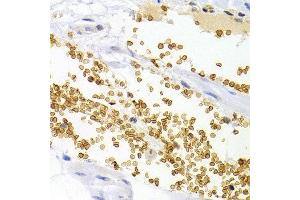 Immunohistochemistry of paraffin-embedded human stomach cancer using OPRL1 antibody at dilution of 1:200 (400x lens). (OPRL1 抗体)