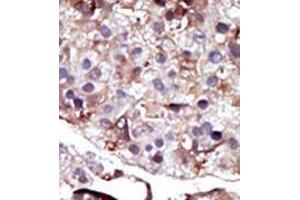 Formalin-fixed and paraffin-embedded human cancer tissue (hepatocarcinoma) reacted with the primary antibody, which was peroxidase-conjugated to the secondary antibody, followed by AEC staining. (SPHK2 抗体  (N-Term))