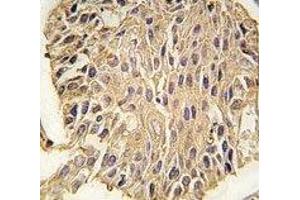 IHC analysis of FFPE human lung carcinoma tissue stained with ALDOA antibody (ALDOA 抗体  (AA 303-331))