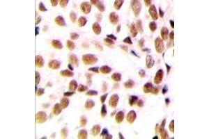 Immunohistochemical analysis of NFYB staining in human breast cancer formalin fixed paraffin embedded tissue section. (NFYB 抗体  (N-Term))