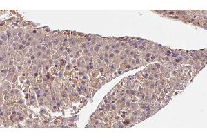 ABIN6272844 at 1/100 staining Human liver cancer tissue by IHC-P.