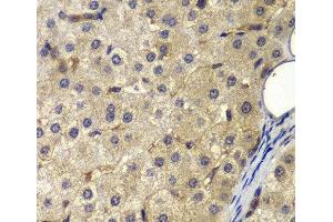 Immunohistochemistry of paraffin-embedded Human liver cancer using AP2A2 Polyclonal Antibody at dilution of 1:200 (40x lens). (AP2A2 抗体)