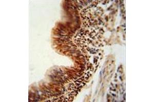 Formalin fixed, paraffin embedded human lung carcinoma stained with RBM43 antibody (N-term) followed by peroxidase conjugation of the secondary antibody and DAB staining. (RBM43 抗体  (N-Term))