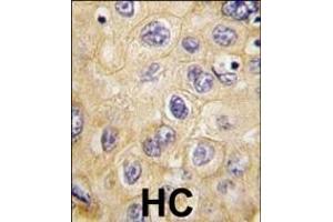 Formalin-fixed and paraffin-embedded human hepatocarcinoma tissue reacted with hCLDN1-Loop1 (ABIN390289 and ABIN2840728) , which was peroxidase-conjugated to the secondary antibody, followed by DAB staining. (Claudin 1 抗体  (AA 40-82))