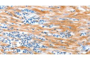 Immunohistochemistry of paraffin-embedded Human esophagus cancer using ALDOB Polyclonal Antibody at dilution of 1:40 (ALDOB 抗体)