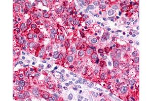 Anti-GPR88 antibody IHC of human Ovary, Carcinoma. (GPR88 抗体  (Cytoplasmic Domain))