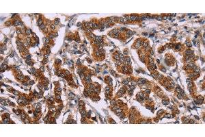 Immunohistochemistry of paraffin-embedded Human breast cancer tissue using ID2 Polyclonal Antibody at dilution 1:30 (Id2 抗体)
