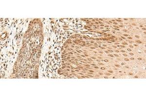 Immunohistochemistry of paraffin-embedded Human esophagus cancer tissue using ARMC8 Polyclonal Antibody at dilution of 1:40(x200) (ARMC8 抗体)