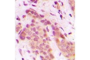Immunohistochemical analysis of CDK8 staining in human breast cancer formalin fixed paraffin embedded tissue section. (CDK8 抗体  (N-Term))