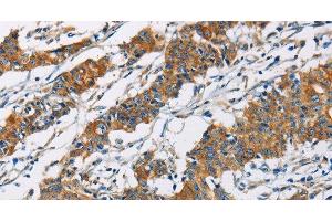 Immunohistochemistry of paraffin-embedded Human gastic cancer using PIP4K2A Polyclonal Antibody at dilution of 1:40 (PIP4K2A 抗体)