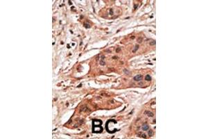 Formalin-fixed and paraffin-embedded human cancer tissue reacted with the primary antibody, which was peroxidase-conjugated to the secondary antibody, followed by DAB staining. (BCL2A1 抗体  (Ala1))