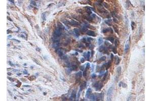 Immunohistochemical staining of formalin-fixed paraffin-embedded human colon carcinoma tissue showing cytoplasmic staining with PTPN12 polyclonal antibody  at 1 : 100 dilution. (PTPN12 抗体  (AA 544-771))