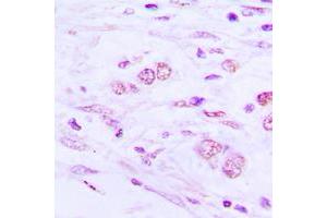 Immunohistochemical analysis of BAIAP2L1 staining in human lung cancer formalin fixed paraffin embedded tissue section. (BAIAP2L1 抗体  (Center))