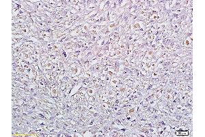 Formalin-fixed and paraffin embedded human cervical carcinoma labeled with Anti Sertad1 Polyclonal Antibody, Unconjugated (ABIN720011) at 1:200 followed by conjugation to the secondary antibody and DAB staining (SERTAD1 抗体  (AA 1-42))