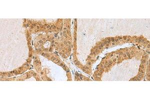 Immunohistochemistry of paraffin-embedded Human thyroid cancer tissue using EXOSC4 Polyclonal Antibody at dilution of 1:50(x200) (EXOSC4 抗体)