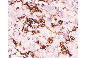 IHC-P: LFA-1 antibody testing of human lung cancer tissue (ITGAL 抗体  (AA 404-769))