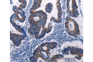 Immunohistochemistry of Human colon cancer using DUSP6 Polyclonal Antibody at dilution of 1:50 (DUSP6 抗体)