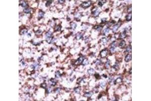 IHC analysis of FFPE human hepatocarcinoma stained with the BACE2C antibody (BACE2C 抗体  (AA 310-339))