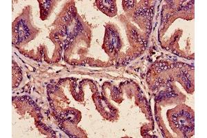Immunohistochemistry of paraffin-embedded human prostate cancer using ABIN7149190 at dilution of 1:100 (Cytochrome C1 抗体  (AA 85-325))