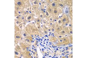 Immunohistochemistry of paraffin-embedded human liver injury using CARD11 antibody (ABIN5974295) at dilution of 1/100 (40x lens). (CARD11 抗体)