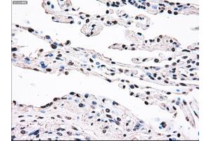 Immunohistochemical staining of paraffin-embedded prostate tissue using anti-SSBmouse monoclonal antibody. (SSB 抗体)