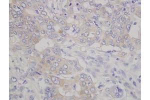 Human pancreatic cancer (formalin-fixed, paraffin embedded) stained with human lumican antibody.