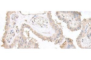 Immunohistochemistry of paraffin-embedded Human thyroid cancer tissue using STAU2 Polyclonal Antibody at dilution of 1:45(x200) (Double-stranded RNA-binding protein Staufen homolog 2 (STAU2) 抗体)
