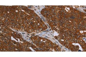 Immunohistochemistry of paraffin-embedded Human ovarian cancer using MCHR1 Polyclonal Antibody at dilution of 1:30 (MCHR1 抗体)